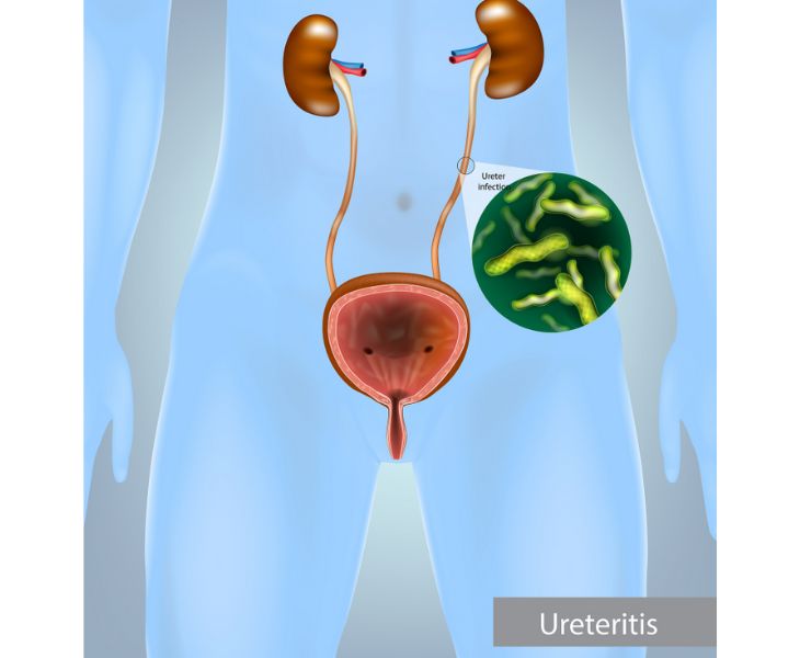 Methenamine-for-UTIs